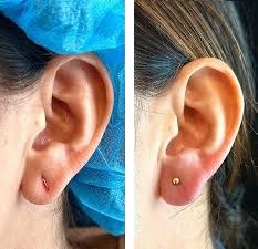 Loboplastia caso 4 — antes y después